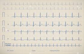 Ecg Chart Image Of Medical Patient Vector Illustration