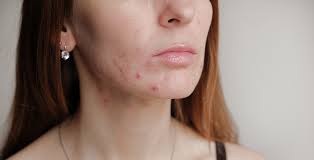 Inflammation of the skin membrane; Cystic Acne And Nodular Acne Overview Causes Symptoms Rxsaver