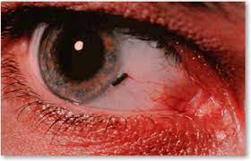 Vision care center is the standard for all eye related needs with state of the art diagnostic machines, courteous staff and knowledgeable, competent doctors. Emergency Eye Care Optometrist In Manhattan Beach Ca Stein Optometric Center