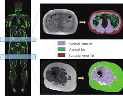 Slowing or reversing muscle loss — researcher nathan k. Sarcopenia Evaluation With Mri In Clinically Acquired Whole Body Mri Download Scientific Diagram