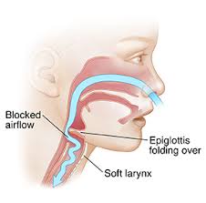It happens when a baby's larynx (or voice box) is soft and floppy. Cuando Su Hijo Tiene Laringomalacia Mhealth Org
