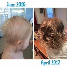We offer 20pcs of different color baby girls hair bows clips:10pcs polka dot bows,and 10pcs pure color bows,using. Baby S Thin Hair Look At How Much Thicker Her Hair Is Started With Revive Shampoo And In January Switched To Thick Hair Remedies Thick Hair Styles Monat Hair