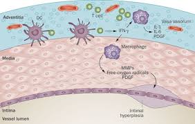 Image result for Polymyalgia Rheumatica