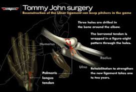 Tommy john surgery (formally known as ulnar collateral ligament reconstruction) is used to treat elbow more sharing options. What Pitchers Need To Know About Tommy John Surgery