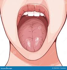 Image result for Fissured tongue