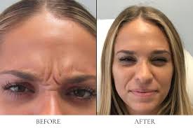 Botox in West Palm Beach