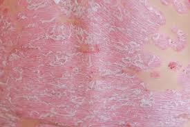 Image result for Pustular Psoriasis