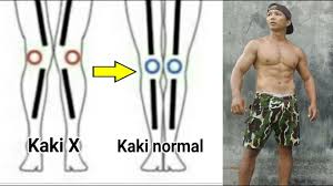 Analisis cairan persendian untuk memeriksa apakah nyeri yang muncul diakibatkan oleh infeksi atau kristal asam urat. Cara Memperbaiki Kaki X Menjadi Normal Secara Alami Latihan Di Rumah Otan Gj Youtube