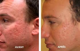 J'ai filmé cette vidéo à la suite de deux peeling effectués et je me suis dit qu'au vu des résultats en si peu de temps cela pourrait. Les Cicatrices D Acne