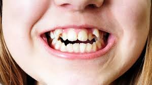 How to fix an overbite? Crooked Teeth Causes How To Fix And Straight Crooked Tooth Dentist In San Rafael Ca