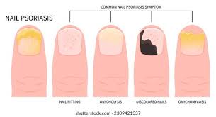 Image result for Koilonychia feet