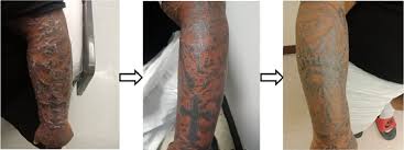 With the rise in covid cases in the area as well as our staff spending the holidays with family, we feel that the responsible thing for us to do is all get tested before returning to work. Tattoo Associated Sarcoidosis The American Journal Of Medicine