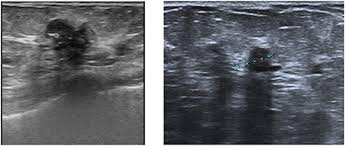 In breast cancer, it means it is totally contained in its original location, the milk duct. Breast Cancer Ultrasound Images Download Scientific Diagram