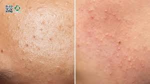 Thời gian điều trị mụn là bao lâu để hết mụn?