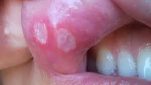 Image result for Oral herpes roof of mouth