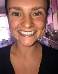Melanoma is the second most common form of skin cancer in young people. Skin Cancer Woman Discovers Basal Cell Carcinoma Near Eye