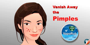 23 Amazing Uses Of Vicks Vaporub I Bet You Didn T Know