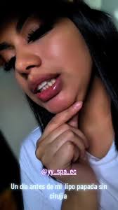 Emocionada 🥳🎊🎊@yy_spa_ec #lipopapadasinvisturi #mesoterapiareductiva  #yyspa #cosmetologiaestetica
