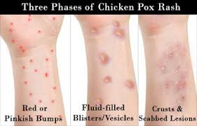 It's rare for chicken pox symptoms to last more than two weeks, starting from the time when blisters first how can you identify chicken pox? Chickenpox Varicella Symptom Evaluation