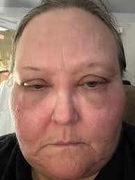 I've been super itchy lately all over my body even my face. I'm taking my  binders regularly with every meal, still no releaf. Dr started Benadryl.  Still no releaf. What else can