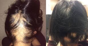 Castor oil has long been used as a remedy for hair loss and thinning hair. Thousands Swear By This Castor Oil To Help Their Hair Grow