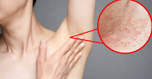 Todos tienen algo en común: Te Salen Granitos Por El Calor No Es Acne Miliaria Como Eliminarla