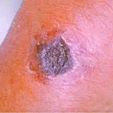 Maybe you would like to learn more about one of these? Buboes In A Victim Of Plague Figure 5 Anthrax Skin Lesion Download Scientific Diagram