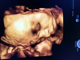 Ideally this, and 14 weeks can instead have a dating scan. Ultrasound Scanning In Pregnancy Saint Mary S Hospital