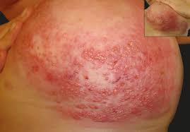 Image result for Inflammatory breast cancer