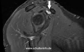 Das Subcoracoidale Impingement