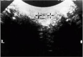 Latest on qb zeke bratkowski including news, stats, videos, highlights and more on nfl.com. Morton S Neuroma Musculoskeletal Key