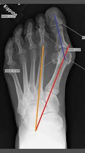 Hallux Valgus Ogam Orthopadie