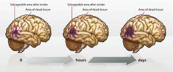 Skin healing is completed by replacing the damaged/lost cells with new ones. Download E Book Brain Repair After Stroke