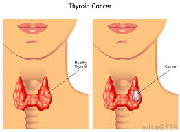 Stage 0 (zero) and stages i through iv (1 through 4). What Is The Connection Between Neck Pain And Cancer