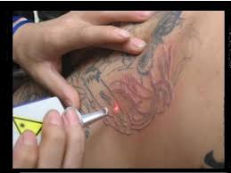 Home tattoo removal methods that don't work. Homemade Natural Tattoo Removal Techniques Adelaide Tattoo