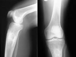 Image result for Osteomyelitis XRay