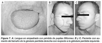 Síndrome de Sjögren: revisión clínica con énfasis en las manifestaciones  dermatológicas