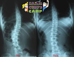 This activity can be varied to suit the resources you have available to you. Onward Toward Scoliosis Prevention Not Just Treatment