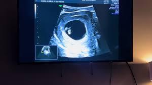 Baby Kimball coming Mach 2024 ❤️ #fyp #babytok #firsttimemom #ultrasound  #march2024👶🏼