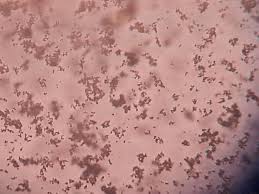 Amorphous Phosphate Crystals Of Urinary Sediment