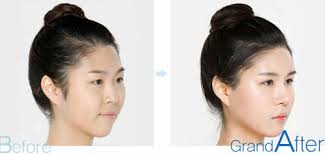 Face symmetry of celebrities beauty. How To Fix A Crooked Face Or Facial Asymmetry Medisetter