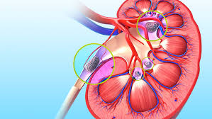 Treatment for true volume depletion: Acute Kidney Failure France Pdf Ppt Case Reports Symptoms Treatment
