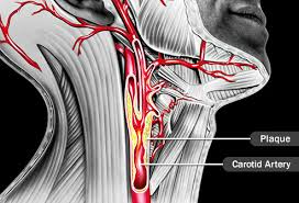 One of these arteries is present on both sides of your neck. Visual Guide To Vein And Artery Problems