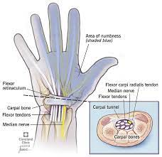 Carpal Tunnel Syndrome Risk Factors Symptoms Treatment