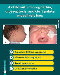 Image result for Micrognathia
