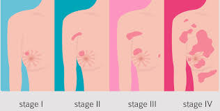Image result for Breast Cancer Staging