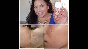 Bio‑oil a remporté 84 prix de soins pour la peau et est devenu le n°1 des ventes de produits contre les cicatrices et vergetures dans 11 pays depuis son fitoform vous propose un complément alimentaire sommeil bio qui est une complexe végétal sans effets secondaires ni accoutumance réalisé à base. Bio Oil Mon Bilan Avant Apres Youtube