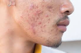 According to one study, acne becomes less common after age 44. How Long Does It Take For Acne Scars To Fade Tiege Hanley