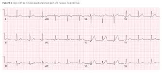 St segment is the flat section of the ecg between end of s and start of the t wave between ventricular depolarization and repolarization ekg. Reviewing The Ecgs Of Ecg Cases 1 With A Link To An Additional Resource On De Winter T Wave Tom Wade Md