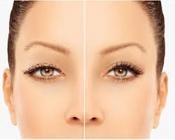 Lower Eyelid Plastic Surgery in Ireland
